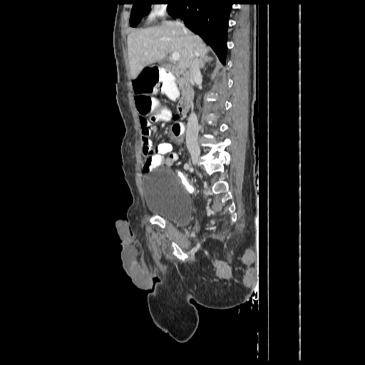 Anorectal carcinoma (Radiopaedia 44413-48064 C 41).jpg