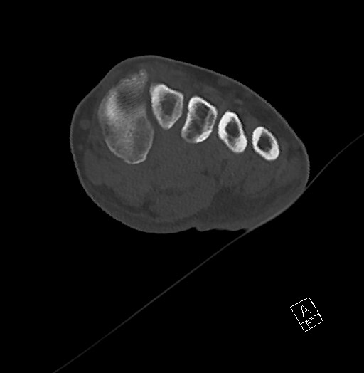 Anterior calcaneal process fracture (Radiopaedia 63353-71943 Axial bone window 69).jpg