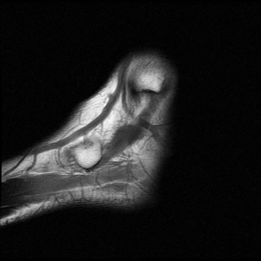 File:Anterior calcaneal process fracture (Radiopaedia 74654-85611 Sagittal T1 2).jpg