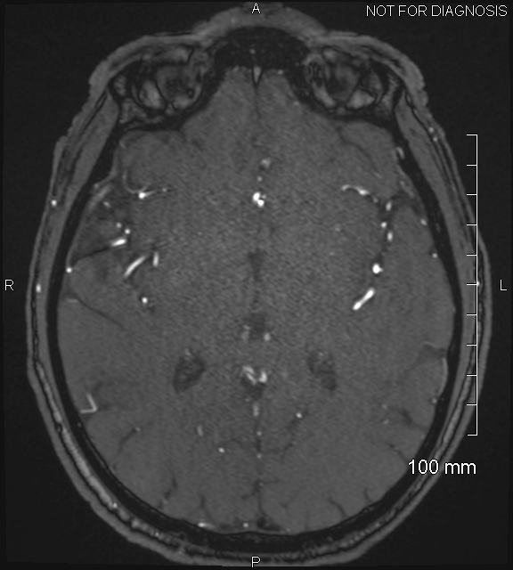 Anterior cerebral artery aneurysm (Radiopaedia 80683-94127 Axial MRA 128).jpg
