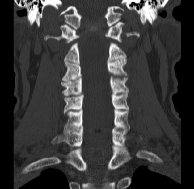 Anterior cervical postdiscectomy arthrodesis (Radiopaedia 32678-33646 Coronal bone window 34).jpg