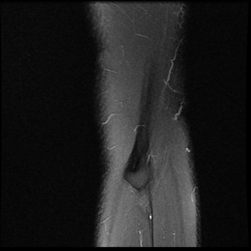 File:Anterior cruciate ligament avulsion fracture (Radiopaedia 58939-66193 Sagittal PD fat sat 1).jpg