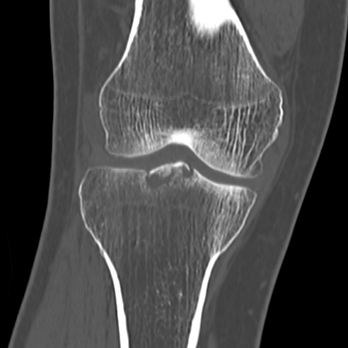File:Anterior cruciate ligament avulsion fracture (Radiopaedia 58939-66194 Coronal bone window 14).jpg