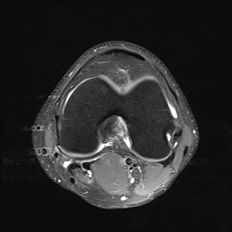 File:Anterior cruciate ligament full thickness tear (Radiopaedia 66268-75467 Axial PD fat sat 15).jpg
