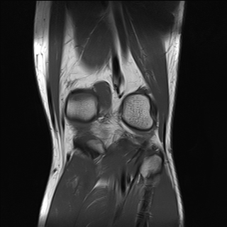 File:Anterior cruciate ligament full thickness tear (Radiopaedia 66268-75467 Coronal T1 16).jpg