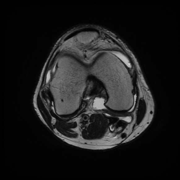 File:Anterior cruciate ligament graft tear and bucket-handle tear of medial meniscus (Radiopaedia 75867-87255 Axial T2 12).jpg