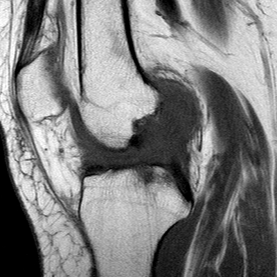 Anterior cruciate ligament mucoid degeneration (Radiopaedia 60853-68633 Sagittal T1 44).jpg