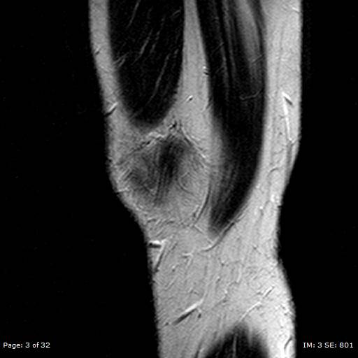 File:Anterior cruciate ligament tear (Radiopaedia 70783-80964 Sagittal T2 3).jpg