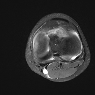 File:Anterior cruciate ligament tear - pediatric (Radiopaedia 62152-70260 Axial PD fat sat 25).jpg