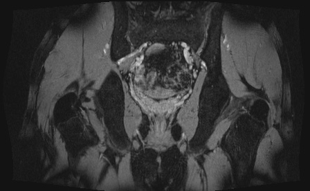 Anterior inferior iliac spine avulsion fracture (Radiopaedia 81312-95000 G 12).jpg