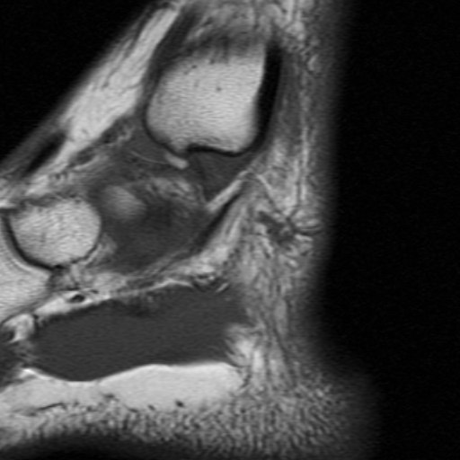 File:Anterior talofibular ligament rupture (Radiopaedia 15831-15484 Sagittal T1 17).jpg