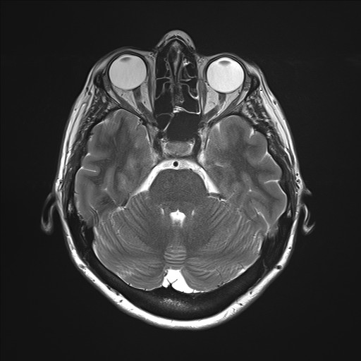 File:Anterior temporal encephalocele (Radiopaedia 82624-96808 Axial T2 11).jpg