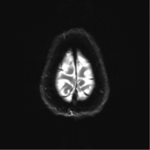 Anterior temporal pole cysts (Radiopaedia 46629-51102 Axial DWI 26).png