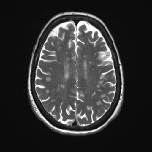 File:Anterior temporal pole cysts (Radiopaedia 46629-51102 C 26).png
