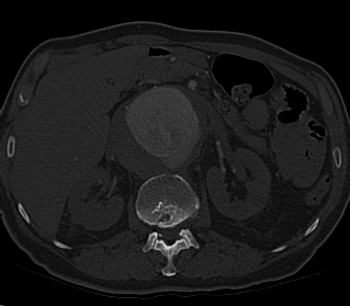 File:Anterior vertebral scalloping (abdominal aortic aneurysm) (Radiopaedia 66744-76067 Axial bone window 26).jpg
