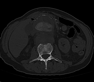 File:Anterior vertebral scalloping (abdominal aortic aneurysm) (Radiopaedia 66744-76067 Axial bone window 3).jpg