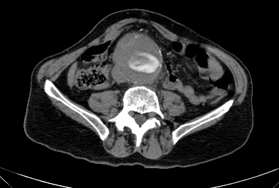 Anterior vertebral scalloping (abdominal aortic aneurysm) (Radiopaedia 66744-76067 F 58).jpg
