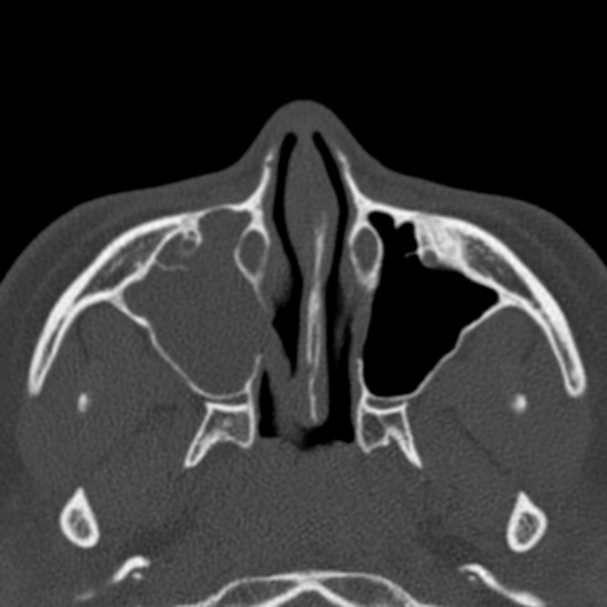Antrochoanal polyp (Radiopaedia 33984-35202 Axial bone window 29).jpg