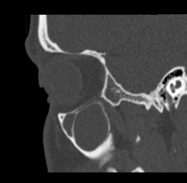 Antrochoanal polyp (Radiopaedia 33984-35202 Sagittal bone window 14).jpg
