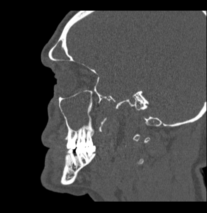 Antrochoanal polyp (Radiopaedia 79011-92169 Sagittal bone window 58).jpg