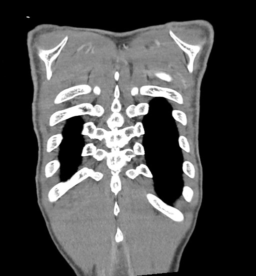 Aortic coarctation with aneurysm (Radiopaedia 74818-85828 C 108).jpg