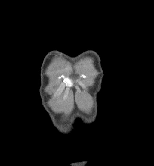 Aortic coarctation with aneurysm (Radiopaedia 74818-85828 C 5).jpg