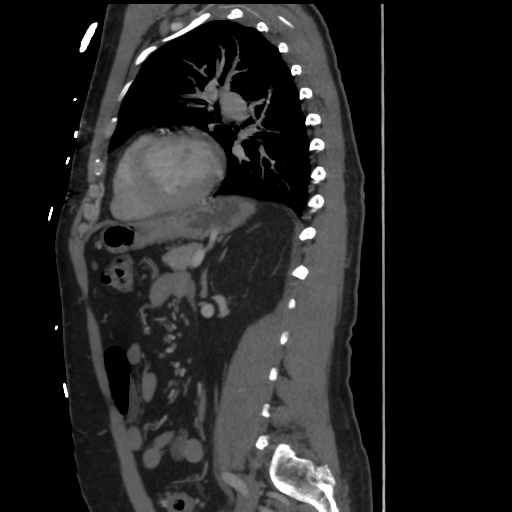 File:Aortic dissection- Stanford A (Radiopaedia 37759-39664 Sagittal C+ delayed 28).png
