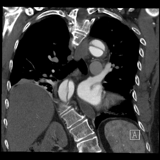 Aortic dissection (CTPA) (Radiopaedia 75506-86750 B 45).jpg
