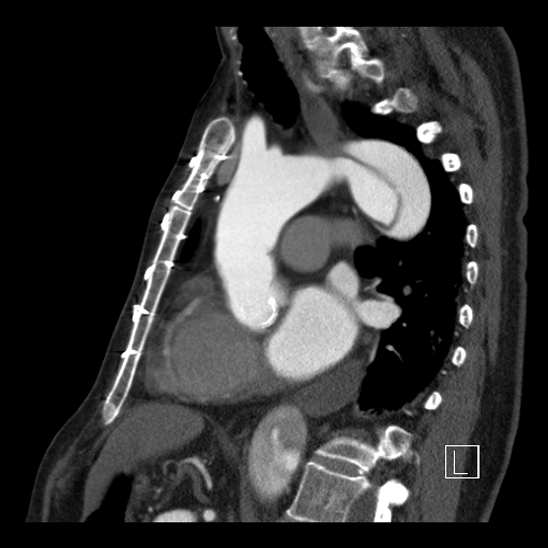File:Aortic dissection (CTPA) (Radiopaedia 75506-86750 C 59).jpg