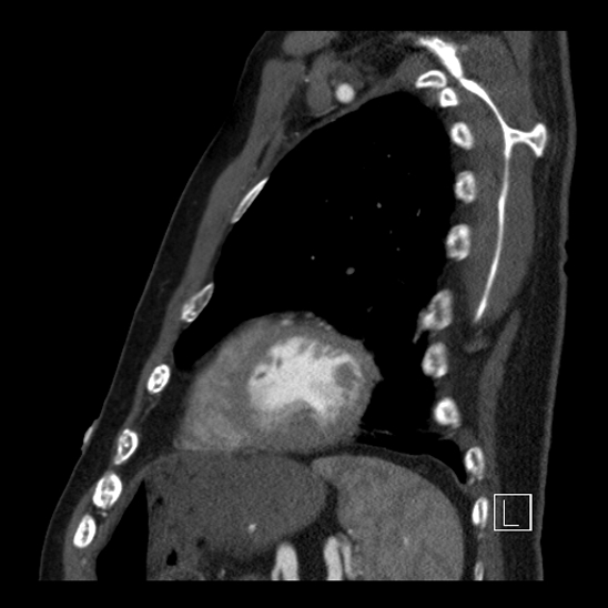 File:Aortic dissection (CTPA) (Radiopaedia 75506-86750 C 83).jpg