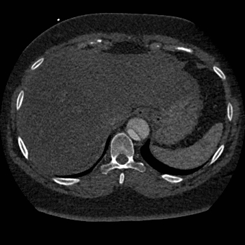 File:Aortic dissection (Radiopaedia 57969-64959 A 271).jpg