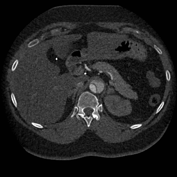 File:Aortic dissection (Radiopaedia 57969-64959 A 330).jpg