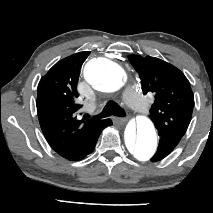 Aortic dissection - DeBakey Type I-Stanford A (Radiopaedia 79863-93115 A 13).jpg