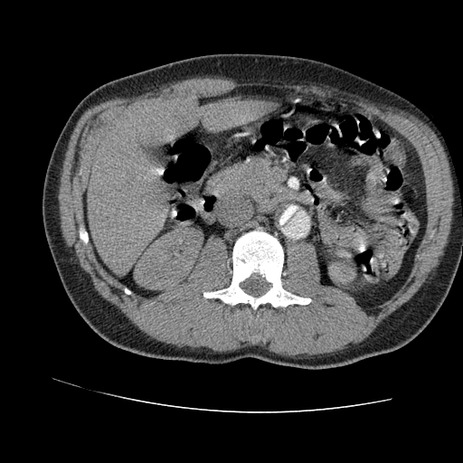 File:Aortic dissection - Stanford A -DeBakey I (Radiopaedia 28339-28587 B 131).jpg