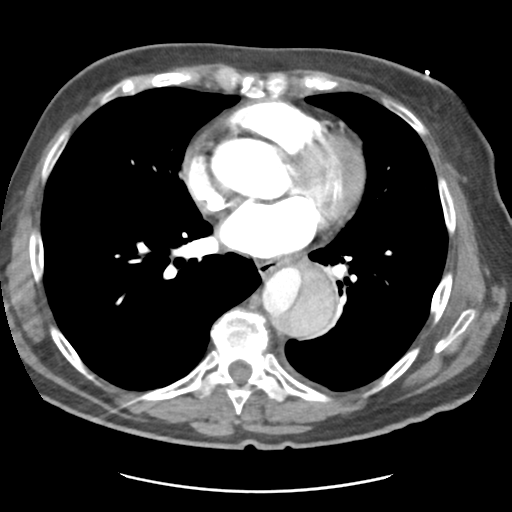 File:Aortic dissection - Stanford type B (Radiopaedia 50171-55512 A 30).png