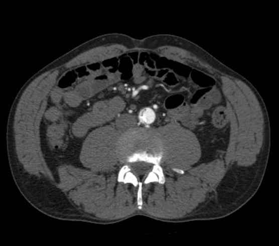 Aortic dissection - Stanford type B (Radiopaedia 73648-84437 A 181).jpg