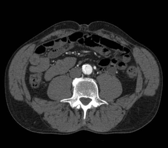 File:Aortic dissection - Stanford type B (Radiopaedia 73648-84437 A 186).jpg