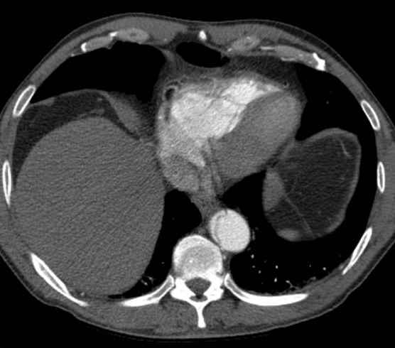 Aortic dissection - Stanford type B (Radiopaedia 73648-84437 A 90).jpg