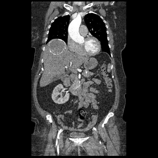 File:Aortic dissection - Stanford type B (Radiopaedia 88281-104910 B 21).jpg
