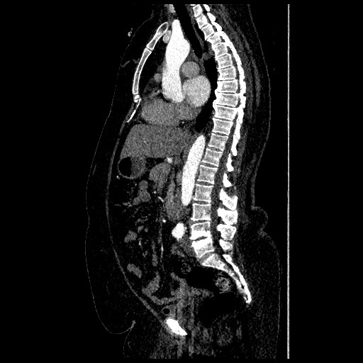 File:Aortic dissection - Stanford type B (Radiopaedia 88281-104910 C 36).jpg