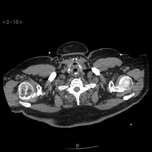 Aortic intramural hematoma (Radiopaedia 48463-53380 Axial non-contrast 5).jpg