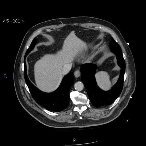 Aortic intramural hematoma (Radiopaedia 48463-53380 C 126).jpg