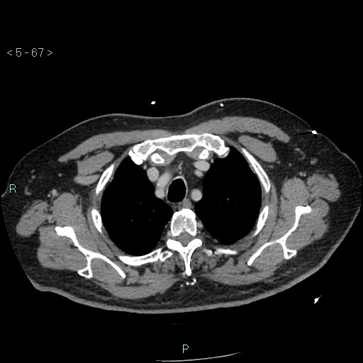 Aortic intramural hematoma (Radiopaedia 48463-53380 C 31).jpg