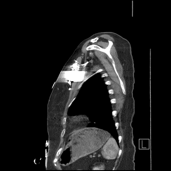 Aortic intramural hematoma with dissection and intramural blood pool (Radiopaedia 77373-89491 D 76).jpg