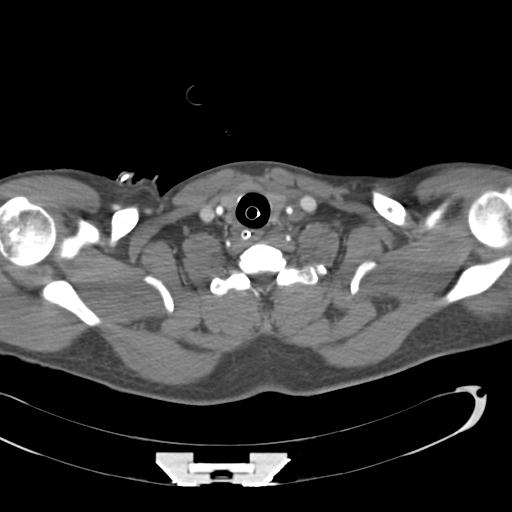 Aortic transection, diaphragmatic rupture and hemoperitoneum in a complex multitrauma patient (Radiopaedia 31701-32622 A 3).jpg