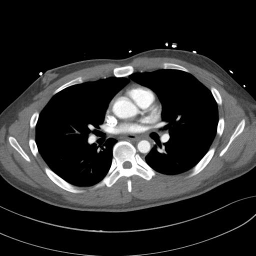 File:Aortic transection (Radiopaedia 29890-30405 A 49).jpg