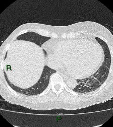 File:Aortic valve endocarditis (Radiopaedia 87209-103485 Axial lung window 74).jpg