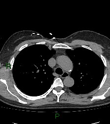File:Aortic valve endocarditis (Radiopaedia 87209-103485 Axial non-contrast 34).jpg