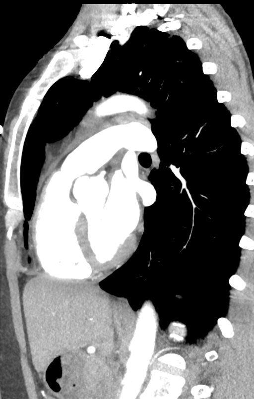 Aortic valve non-coronary cusp thrombus (Radiopaedia 55661-62189 C+ arterial phase 24).png