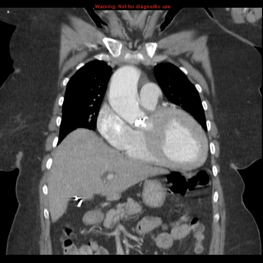 File:Aortic valve stenosis (Radiopaedia 14480-14423 A 4).jpg
